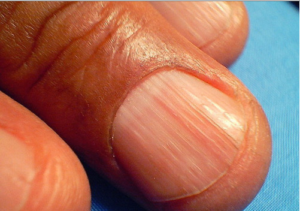 enfermedades de las uñas estrias