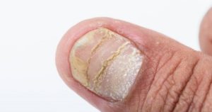 psoriasis de uñas preguntas frecuentes