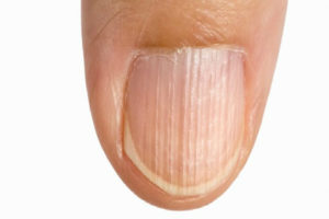  Rayas verticales en las uñas  Actualizado marzo 2023
