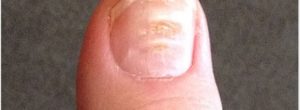 Uñas estriadas